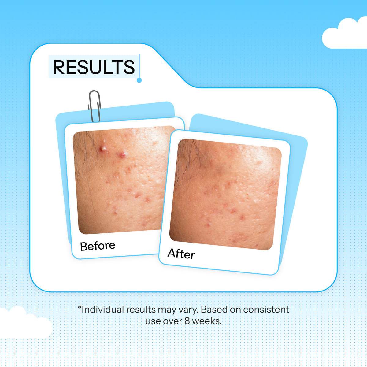 Prebiotic Acne Defense Combo