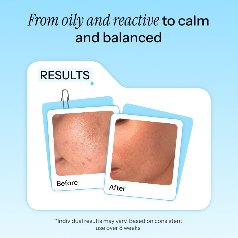 A promotional graphic with the headline 'From oily and reactive to calm and balanced' above a folder labeled 'RESULTS' containing before-and-after skin close-ups. Smaller text at the bottom says results may vary and based on consistent use over 8 weeks.